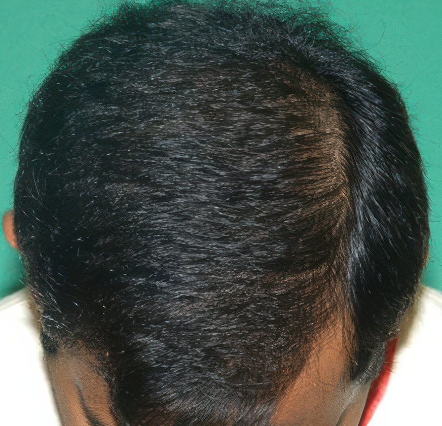 After hair restoration at Chicago Hair Institute