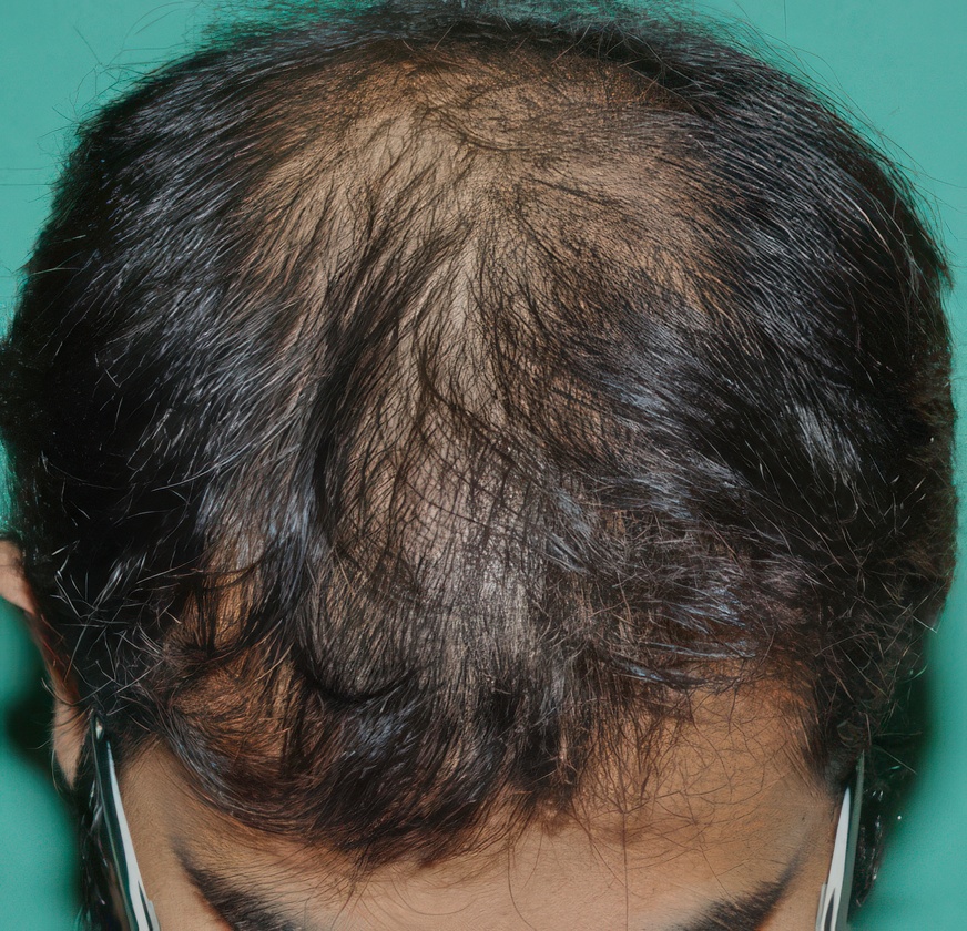 Before hair restoration at Chicago Hair Institute