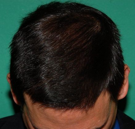 After hair restoration at Chicago Hair Institute