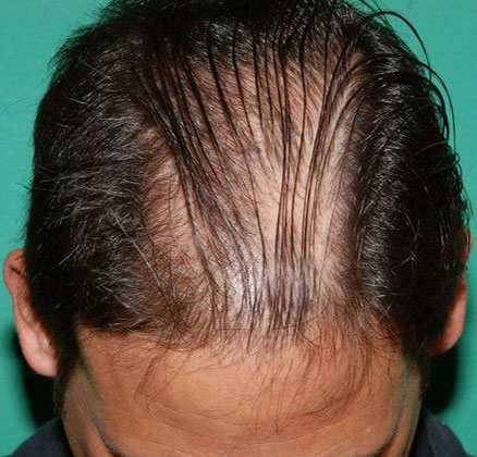Before hair restoration at Chicago Hair Institute