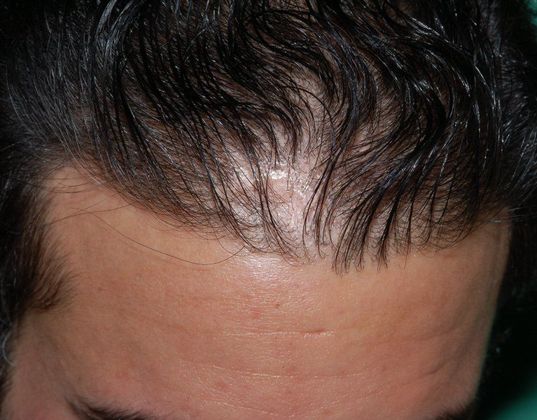 before hair transplant