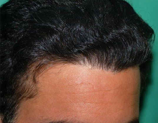 after hair transplant