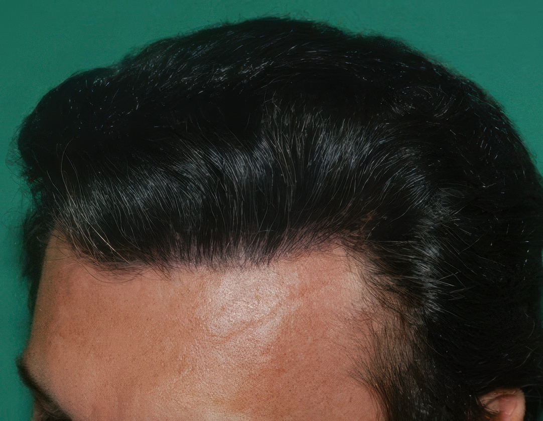 full hairline