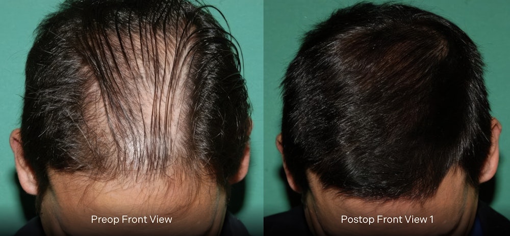 Dr. Konior's patient before and after hair restoration retreatment