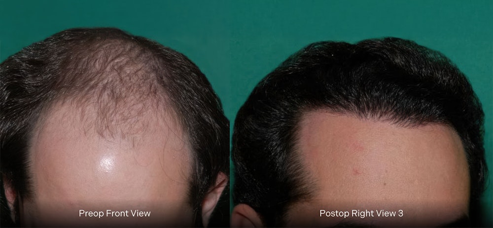 Dr. Konior's patient before and after hair restoration retreatment