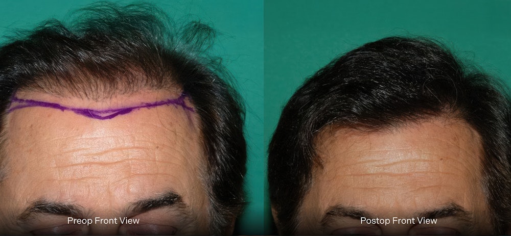 Dr. Konior's patient before and after hair restoration retreatment