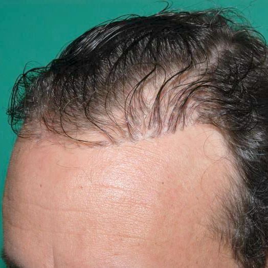 Dr. Konior's patient before hair restoration retreatment