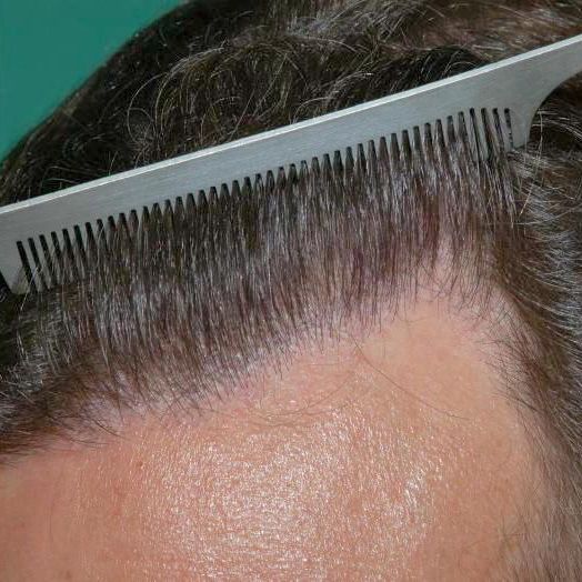 Dr. Konior's patient after hair restoration retreatment