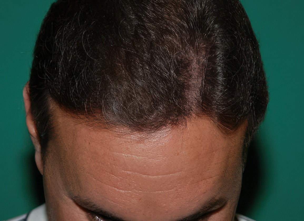 Dr. Konior's patient after hair restoration retreatment