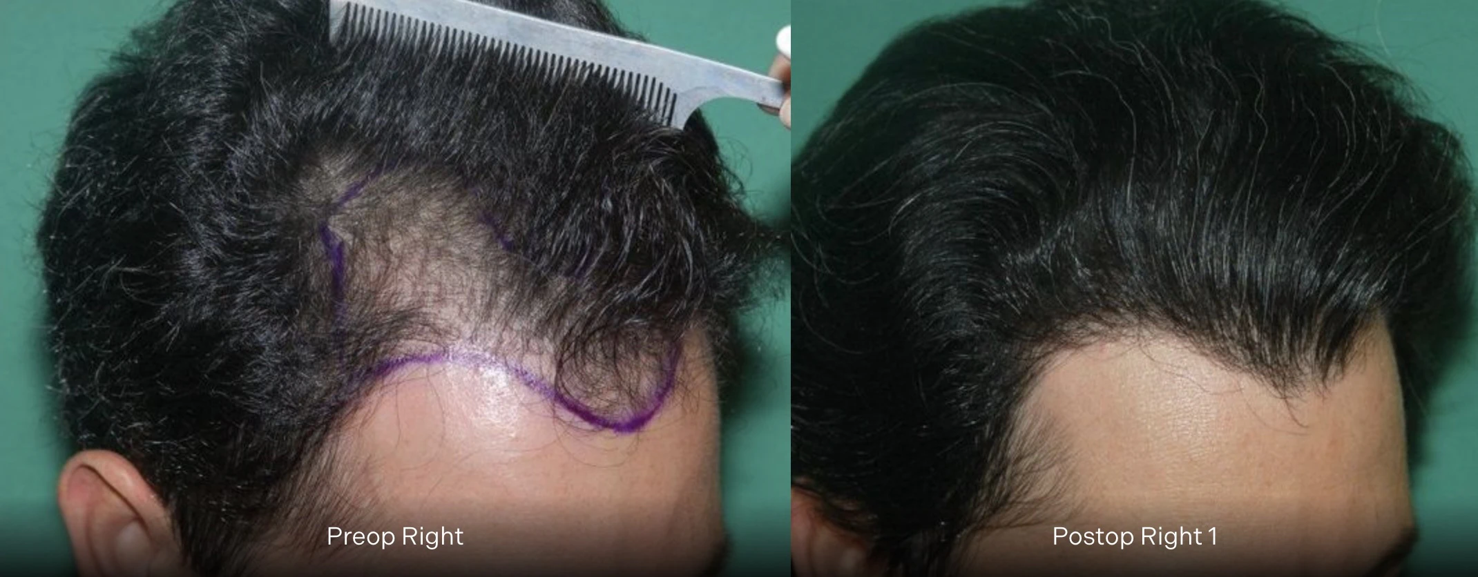 Real patient w/ hair restoration
