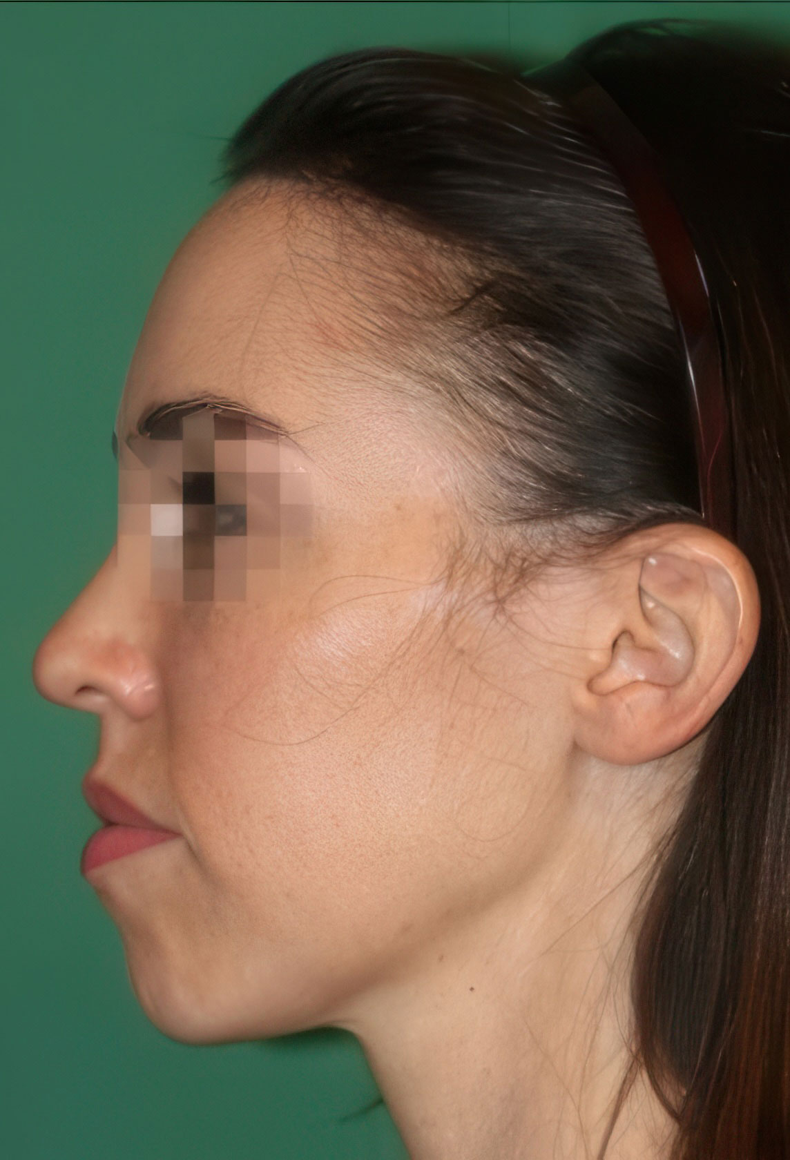 Real female patient after hairline transplant