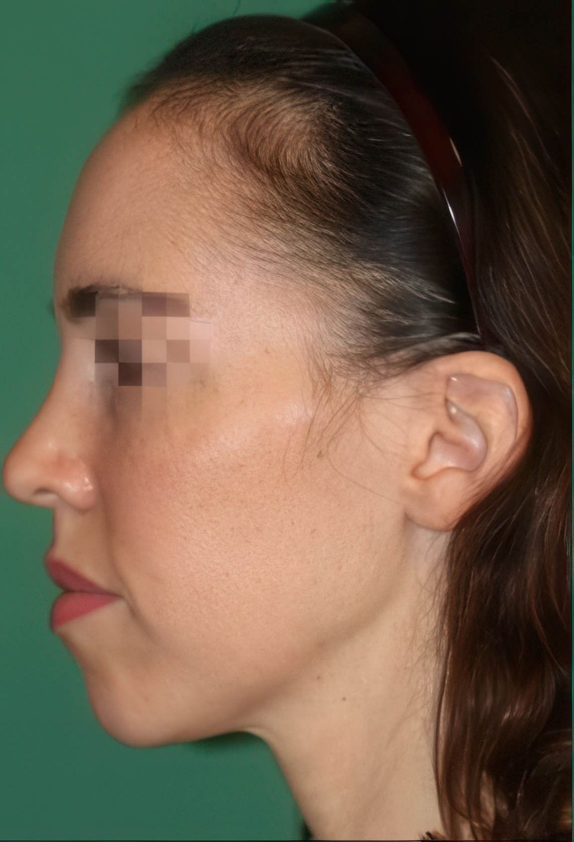 Real female patient before hairline transplant