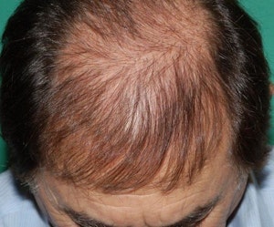 before hair transplant