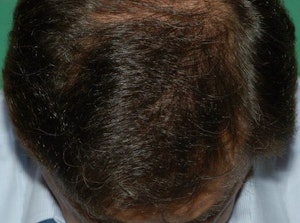 after hair transplant