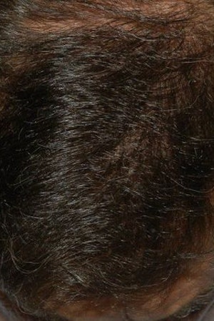 after hair transplant