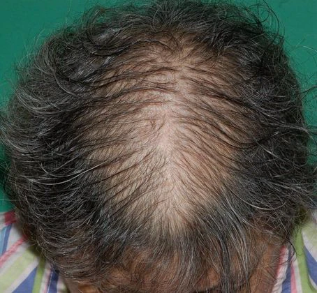 before crown restoration