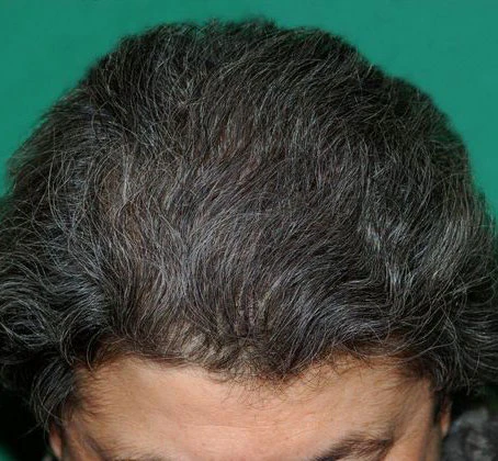 after crown restoration