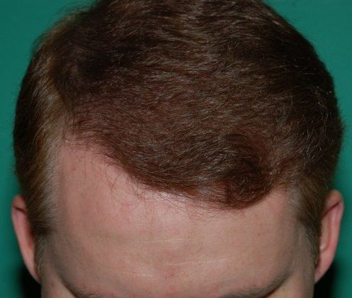 crown follicles restored