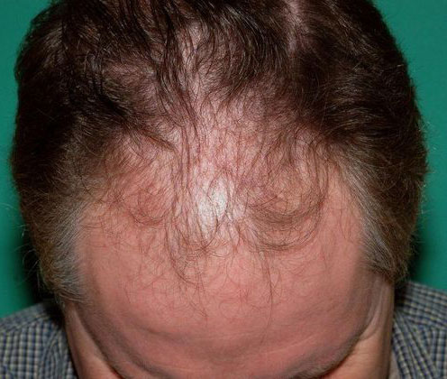 thinning crown follicles
