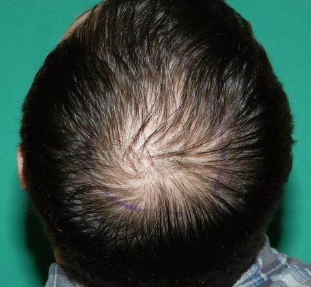 thinning crown