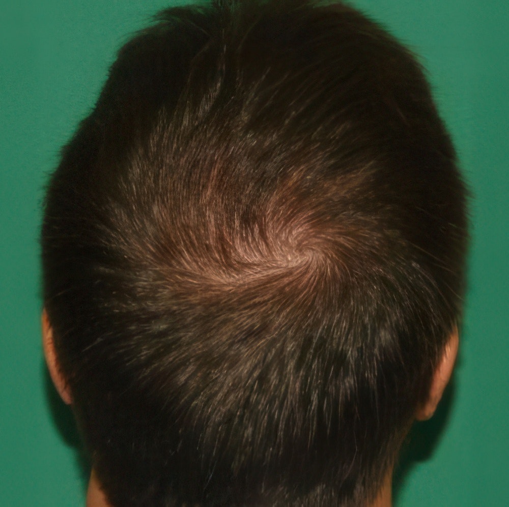 after crown hair transplant