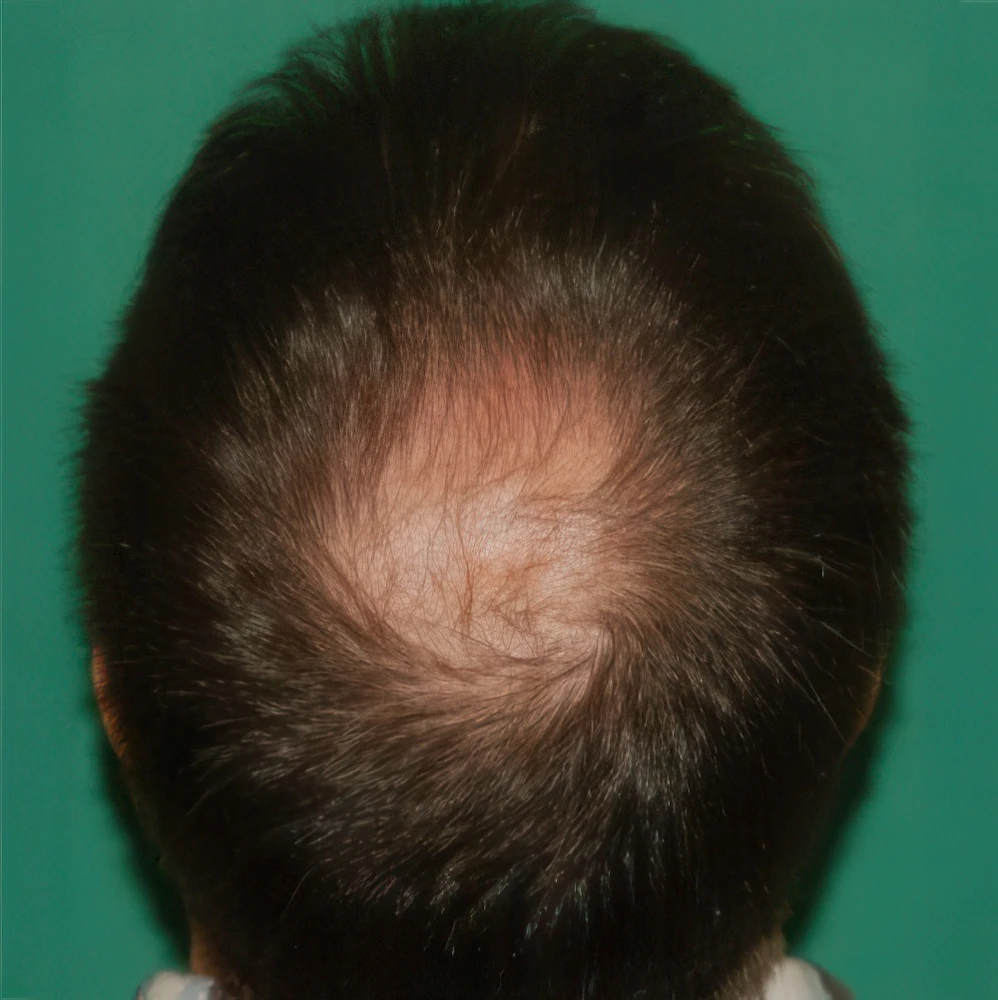 before crown hair transplant