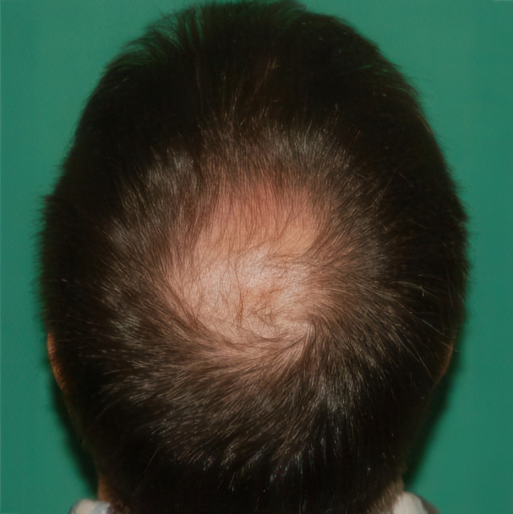 before crown hair transplant
