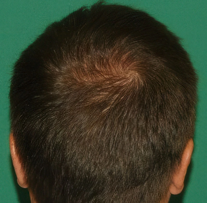 after 3000 graft crown restoration