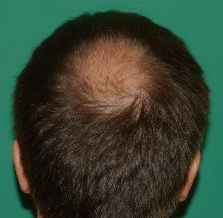 before 3000 graft crown restoration