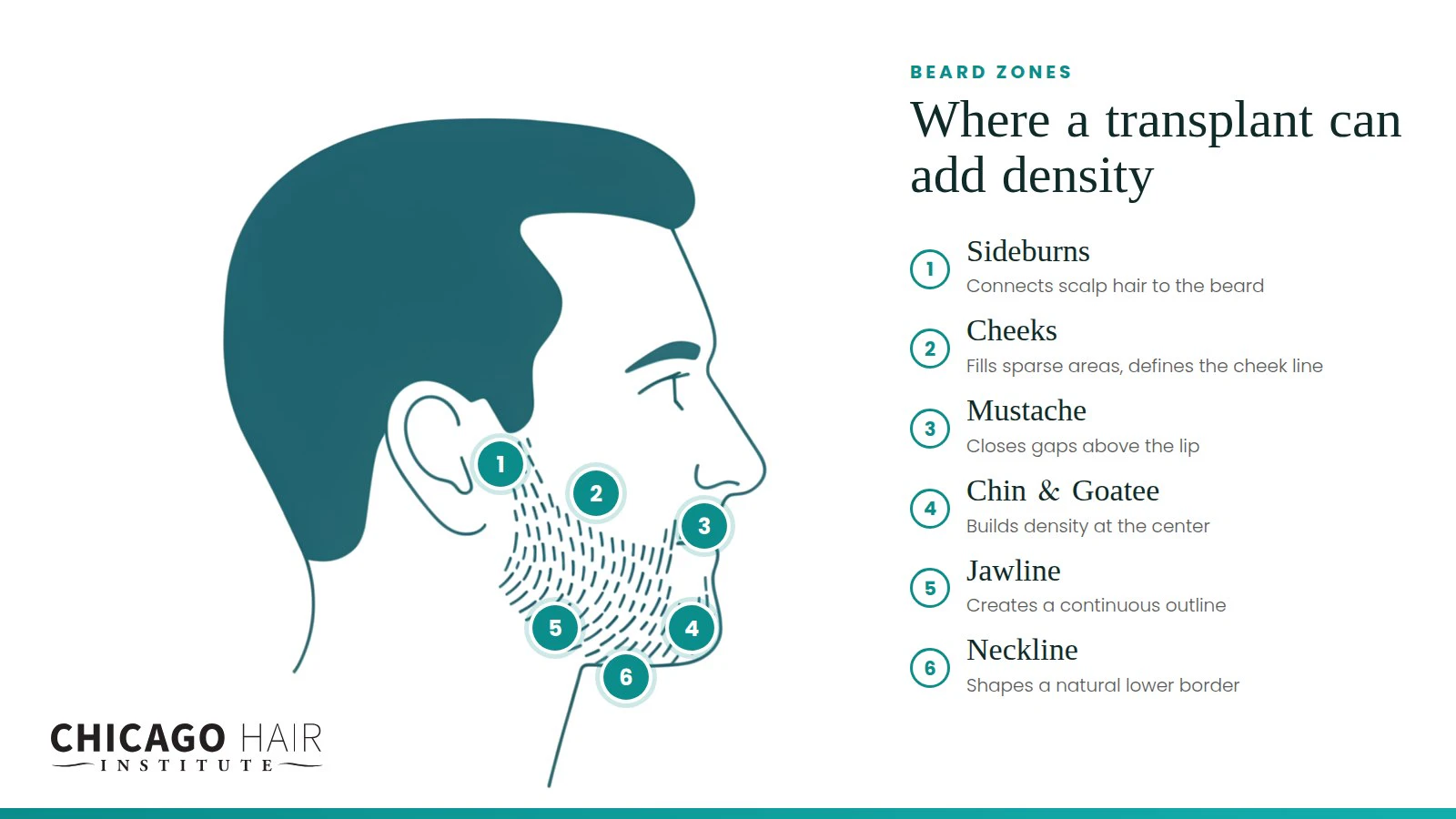 Chicago Hair Institute illustration of six beard zones a transplant can address: sideburns, cheeks, mustache, chin and goatee, jawline, and neckline