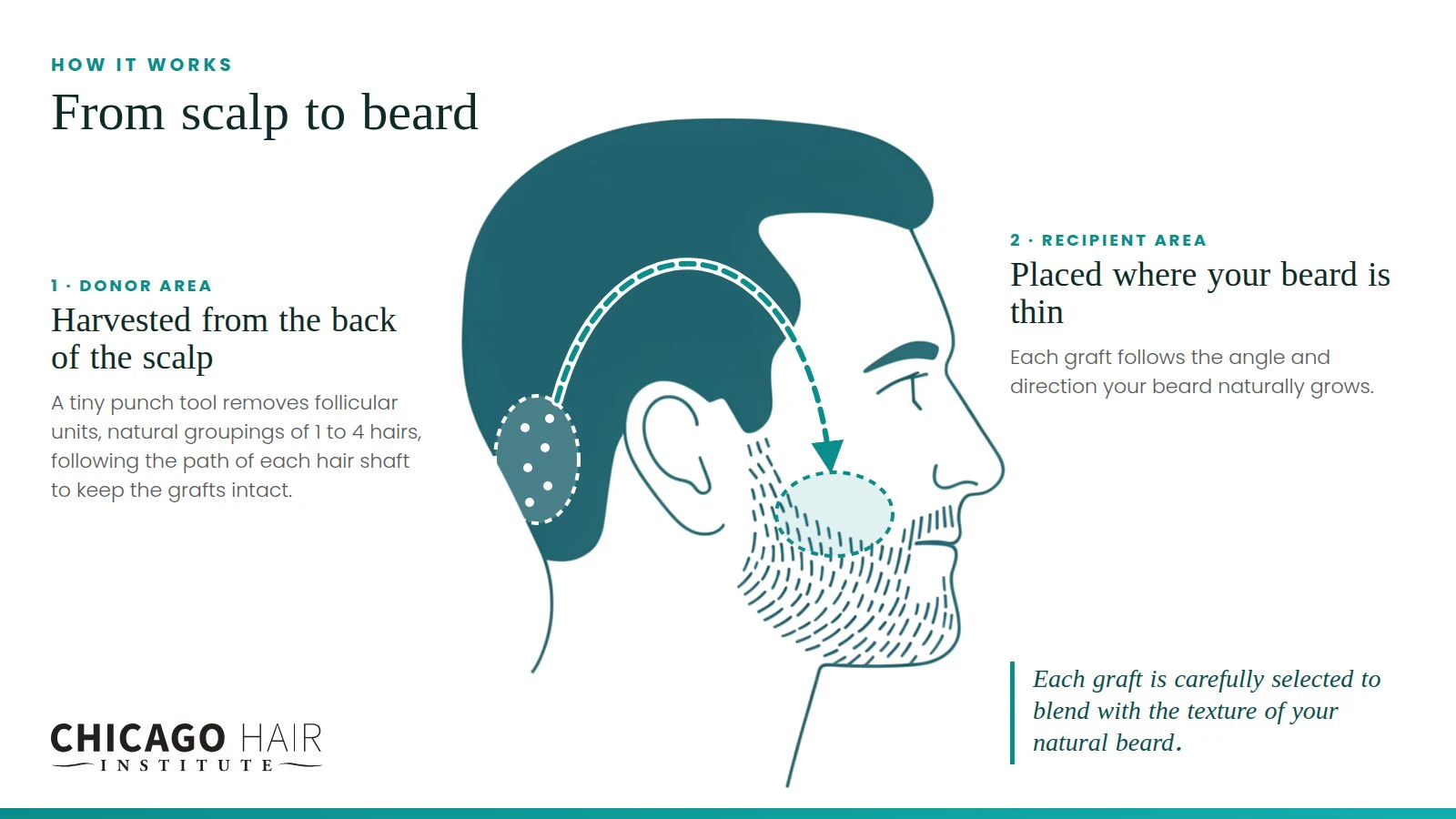 Chicago Hair Institute diagram showing follicular unit grafts harvested from the back of the scalp and placed in thin areas of the beard