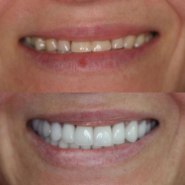 Before and after dental implants treatment