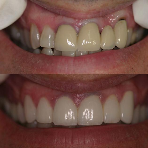 Before and after cosmetic dentistry treatment