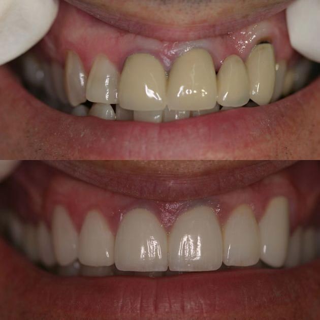 Before and after cosmetic dentistry treatment
