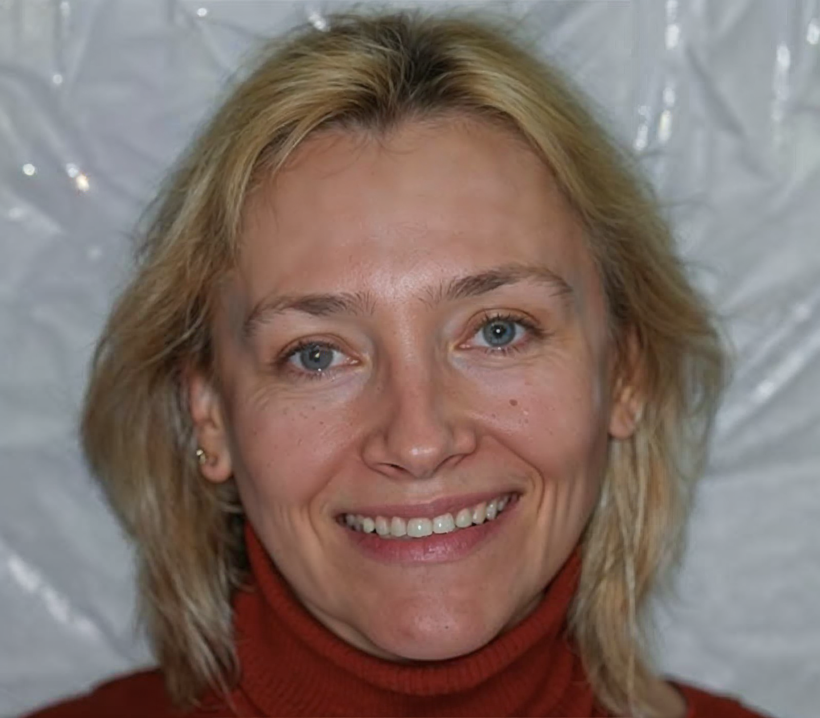 Before full mouth reconstruction