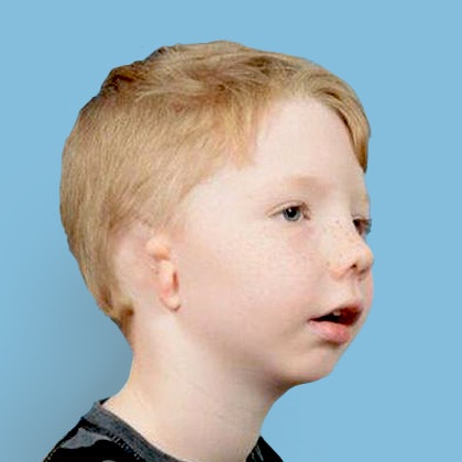 Young microtia patient