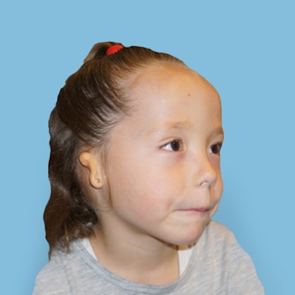 Child with aural atresia