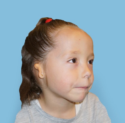 Child with aural atresia