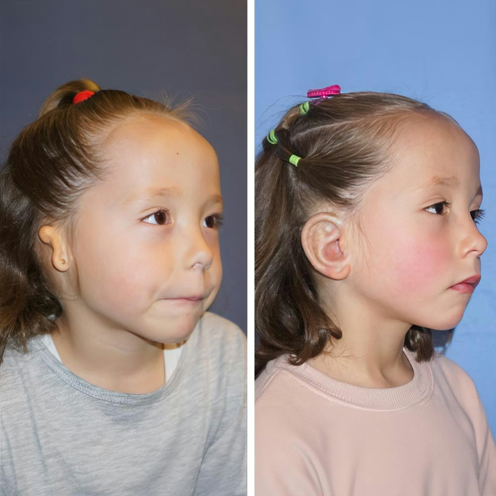 Child before and after reconstructive surgery with Dr. Reinisch