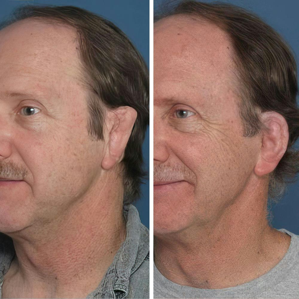 Man before and after revisionary surgery with Dr. Reinisch
