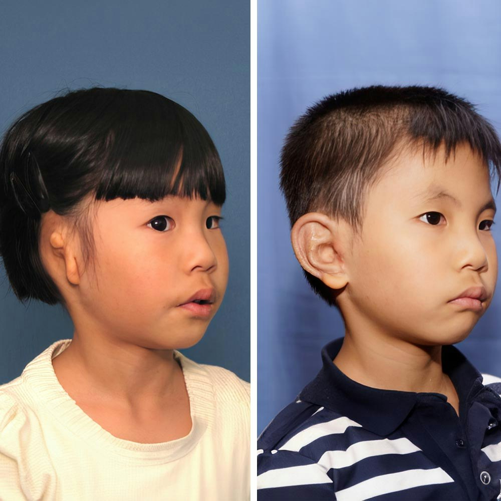 Child before and after microtia surgery with Dr. Reinisch