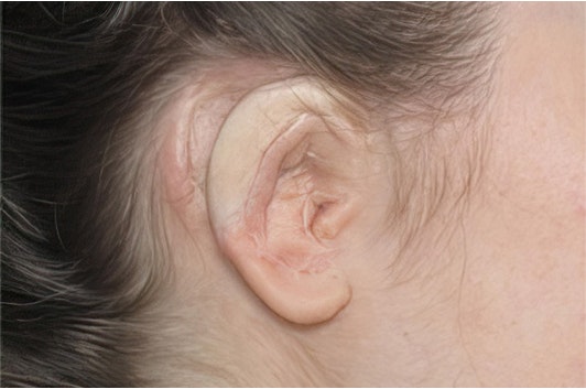 ear repaired with rib cartilage