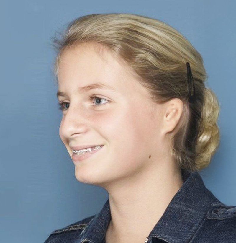 Patient with microtia