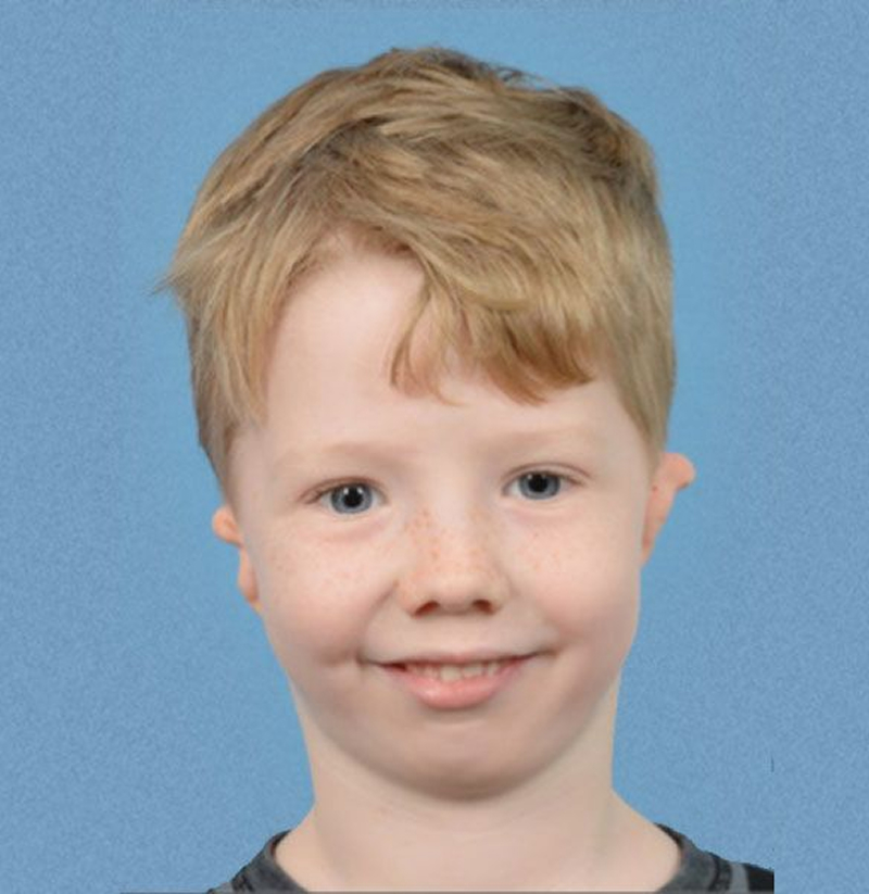 Patient with microtia