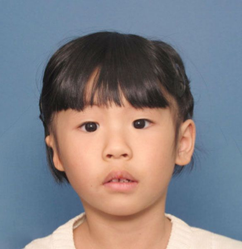 Patient with microtia