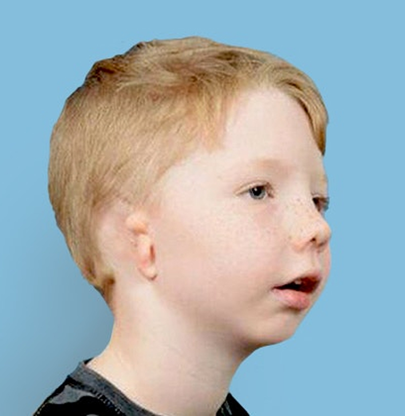 Boy with microtia