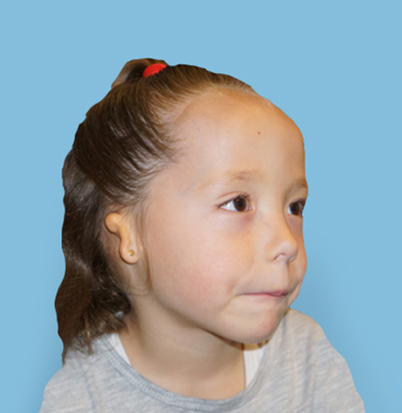 Young girl with microtia