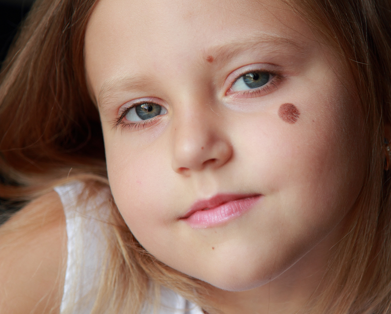 Young girl with a mole