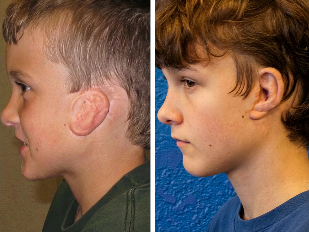 boy before and after microtia surgery