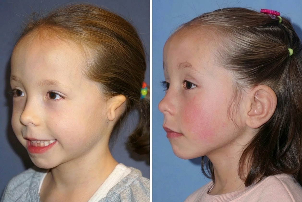 Beverly Hills patient before and after ear reconstruction